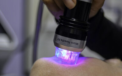 What is Microneedling?