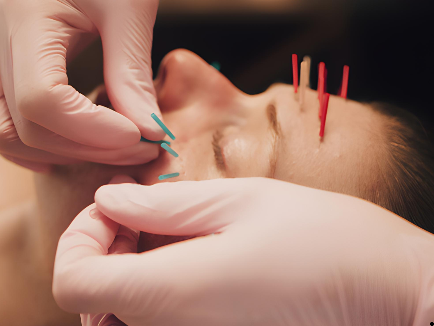 acupuncture A La Carte acupuncture