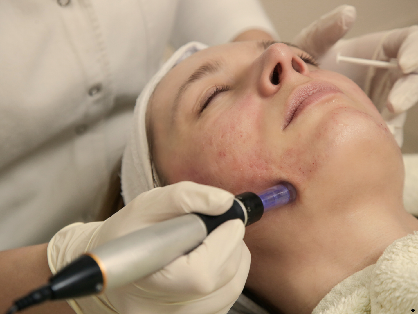 Microneedling for Scars