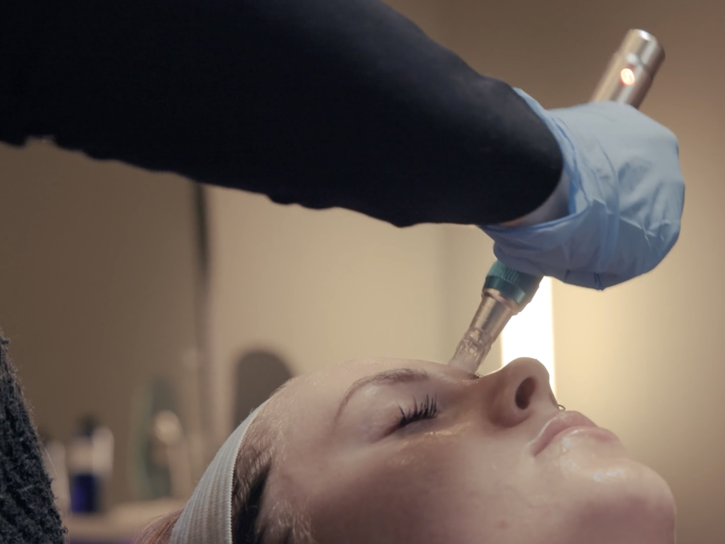 microneedling for face