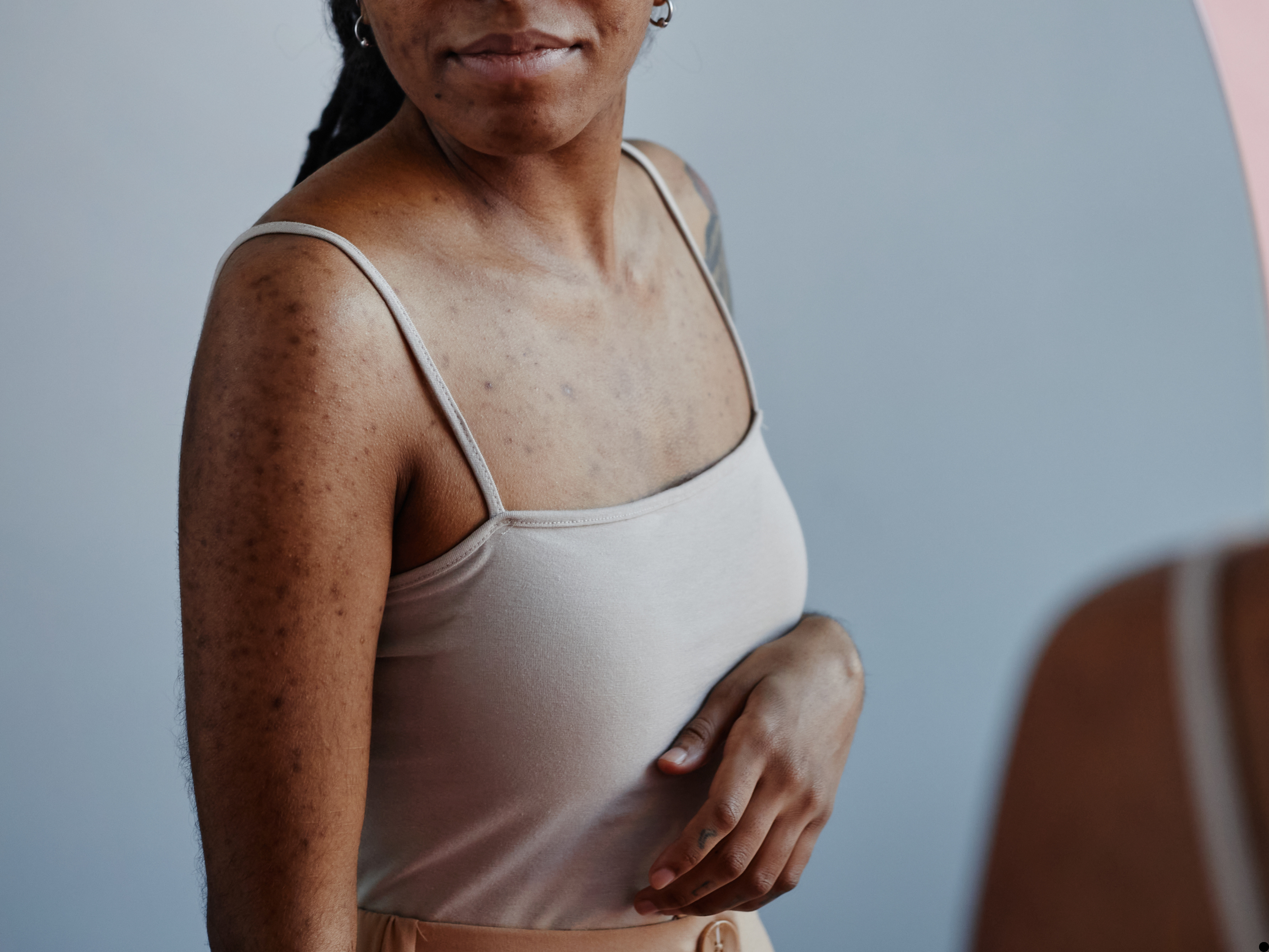 microneedling for face