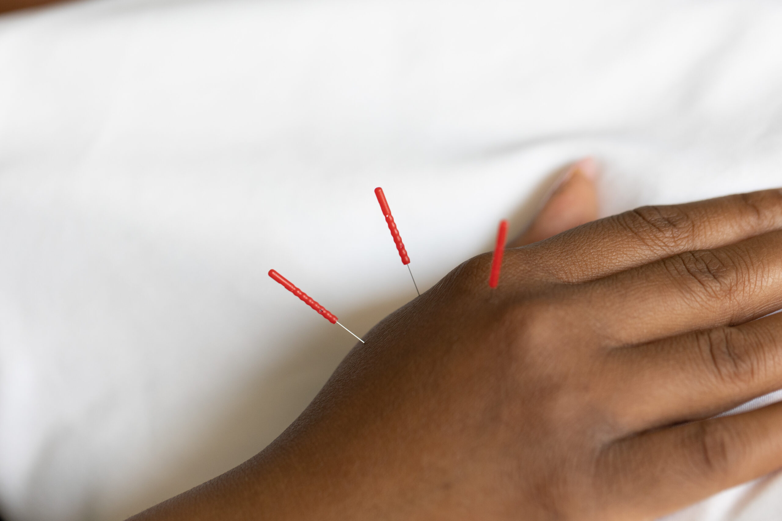 community acupuncture