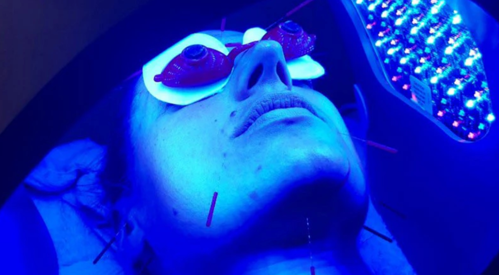 acupuncture for acne