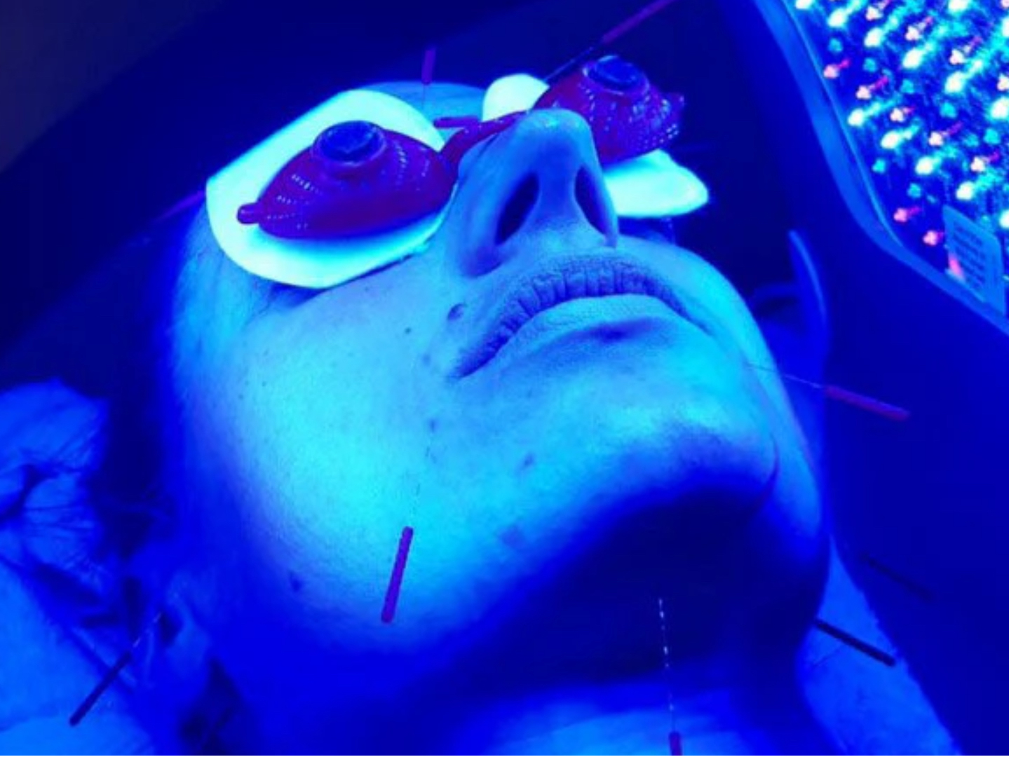 acupuncture for acne