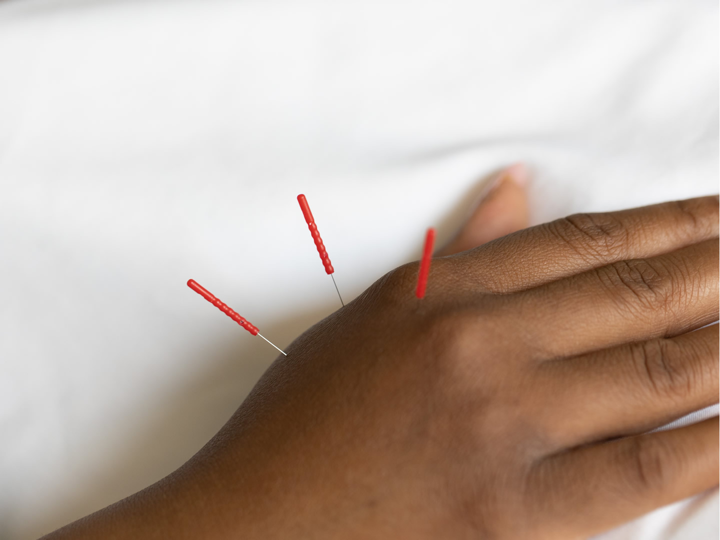 A La Carte acupuncture