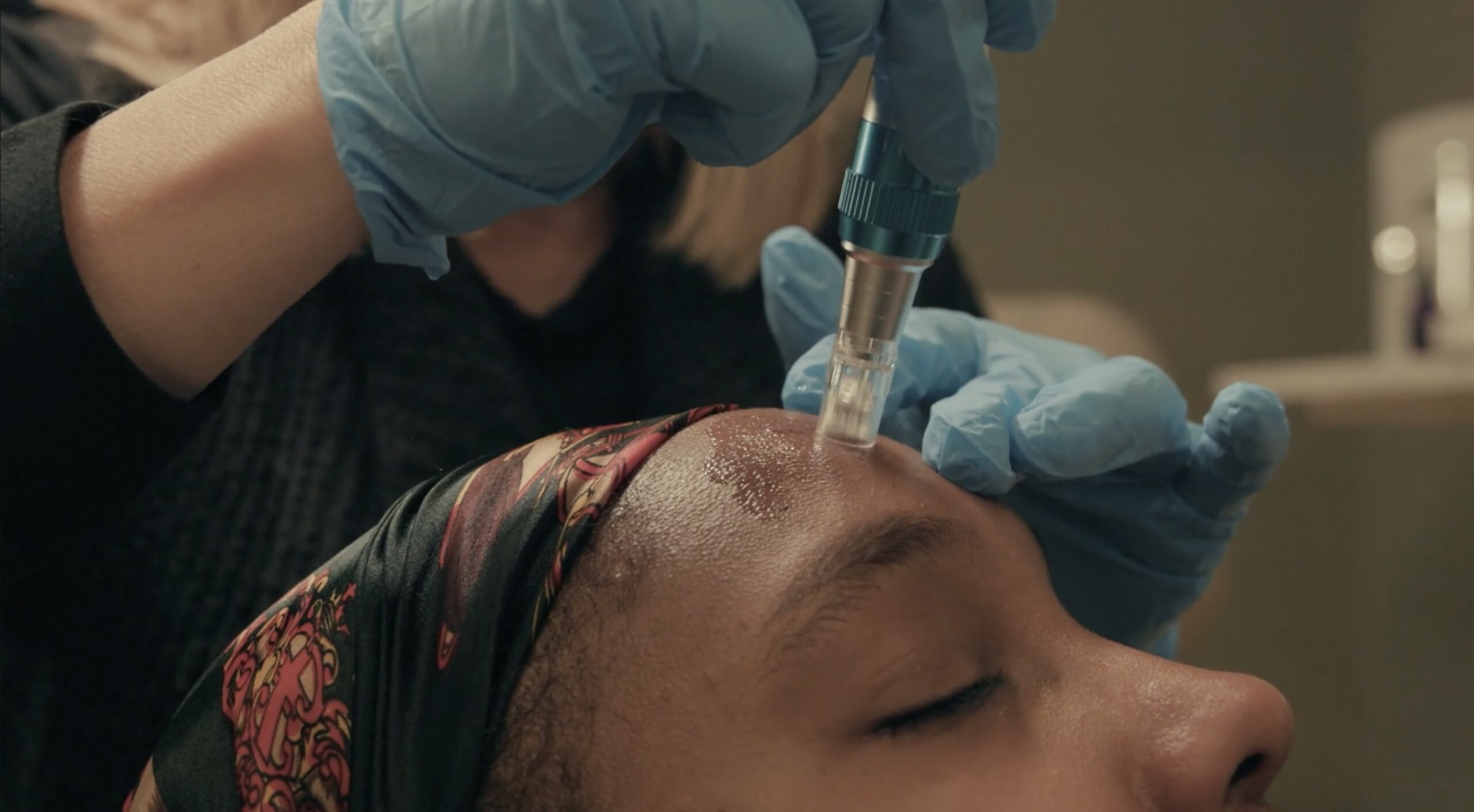 Woman receiving microneedling treatment at Resilient Skin AcuBar near White Marsh, MD