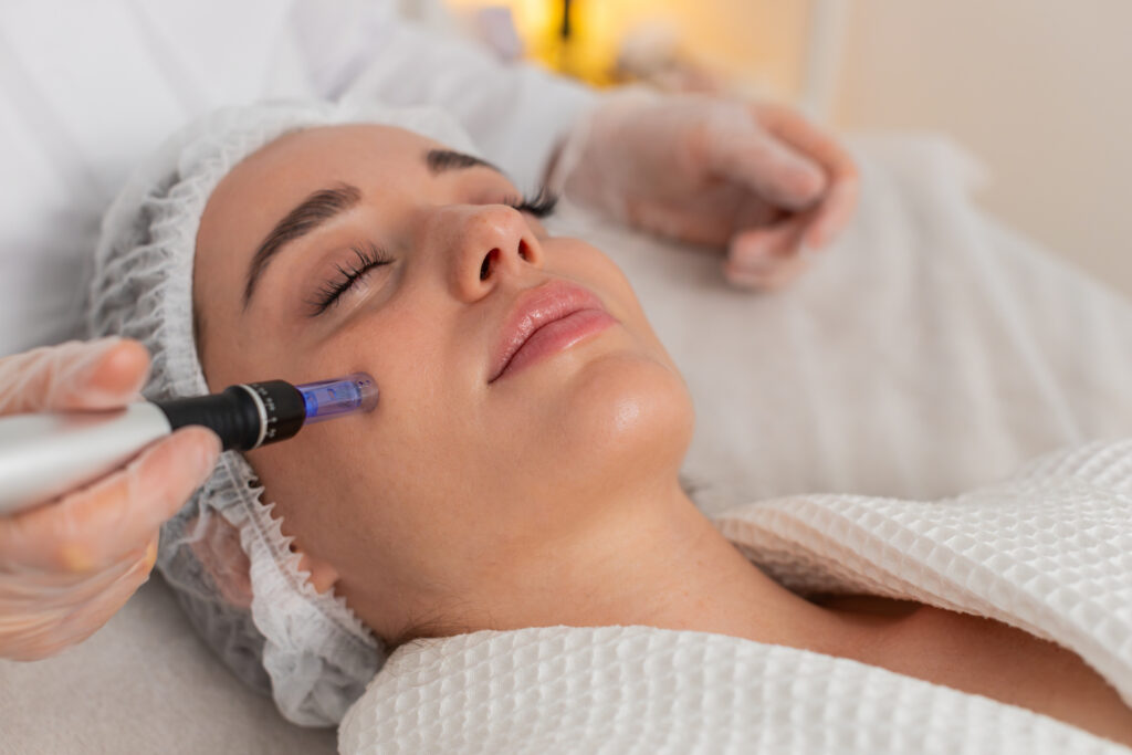 A specialist performs microneedling on a female patient's face for microneedling-sessions-for-acne-scarring blog.