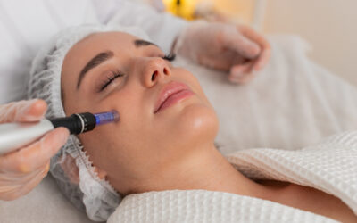 How Many Microneedling Sessions Will I Need for Acne Scarring?